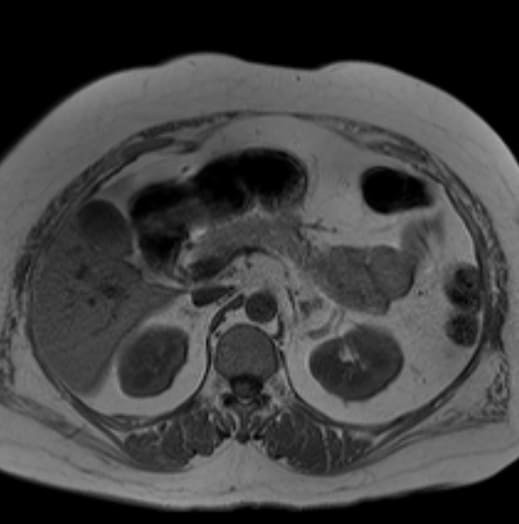 Снимок мягких тканей и органов МРТ забрюшинного пространства